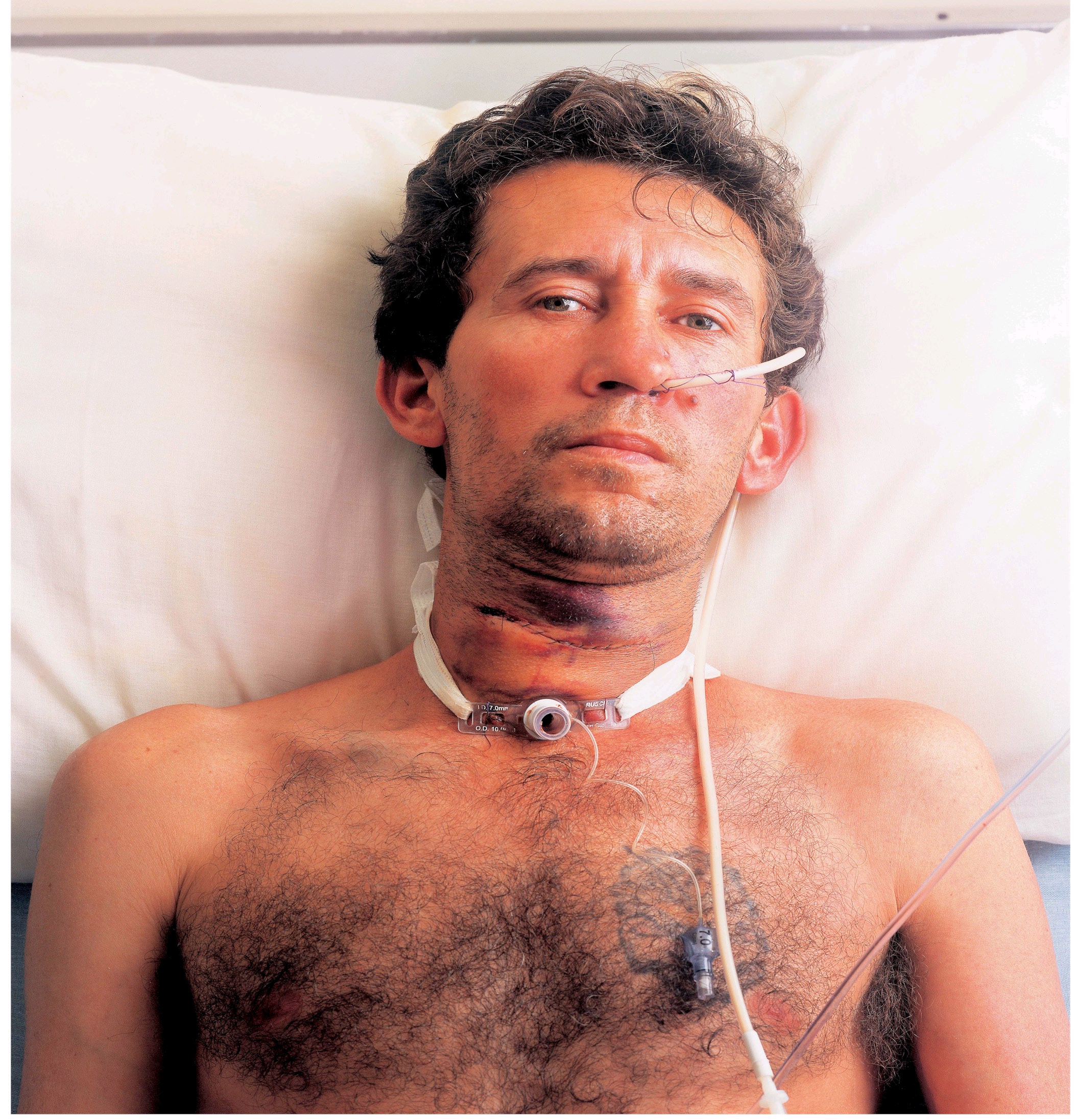 Brazil 2004  Health Effects mouth - larynx cancer, lived experience